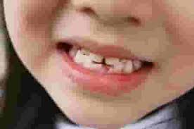Squeeze the tooth firmly and tug. Should You Pull A Loose Baby Tooth When And How To Safely Do So Theasianparent