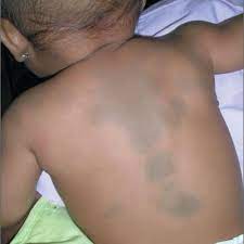 dark spots on child s back mdedge