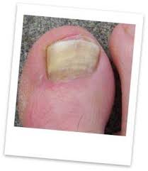 will listerine cure toenail fungus