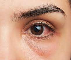 what may cause eyelid swelling eye