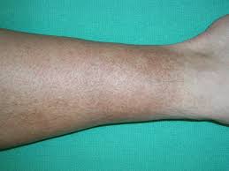 leg discoloration treatment causes