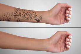 Laser tattoo removal usually takes around 5 to 10 appointments, but the exact number of sessions depends on different factors like the tattoo's size, location, and colors. Laser Tattoo Removal How Long Does The Process Take Princeton Aesthetics