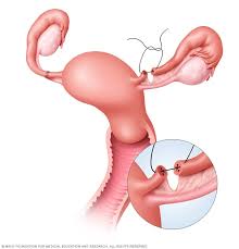 Check spelling or type a new query. Tubal Ligation Reversal Mayo Clinic