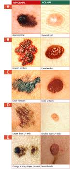 Skin Cancer Abcde Screening Guidelines