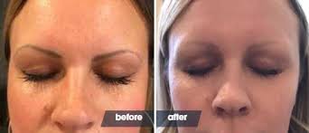how to remove microblading removery