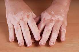 white spots on your skin