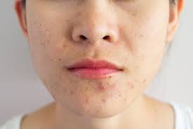 how to get rid of acne according to a