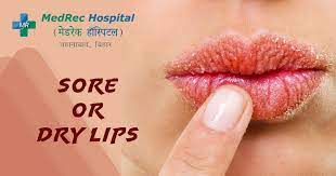 sore lips dry or chapped lips let us
