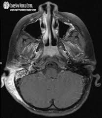 Or did your ob just wait until your next appointment to discuss your results?? Ct Scan Of The Head Brain Cedars Sinai