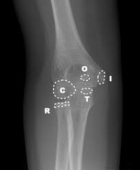Not surprisingly, playing tennis or other racquet sports can cause this condition. Medial Epicondylar Fractures Pediatric Pediatrics Orthobullets