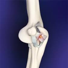 Elbow/forearm tendon ligament tear | health life media. Elbow Ligament Injury Nsw Tendon Repair Surgery Nsw
