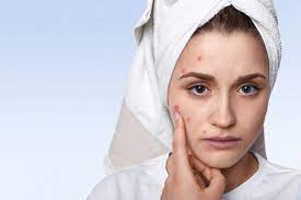 do makeup wipes cause acne how to