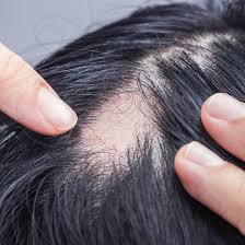 Most people only lose hair in small, round patches. Different Types Of Alopecia Symptoms Treatments Nioxin