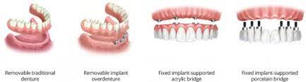 how much are full mouth dental implants