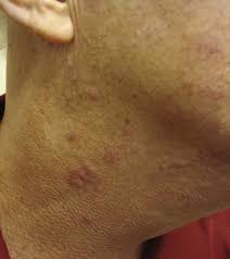 skin disease in cutaneous lupus