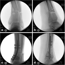 retrograde tibial nailing a minimally