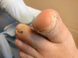 black spot under the toenail causes