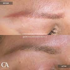 permanent makeup removal chicago