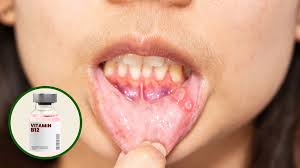 vitamin deficiency causes mouth ulcers