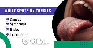 white spots on tonsils causes