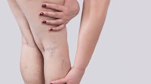 visible leg veins causes solutions