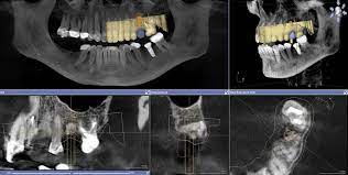 dental cone beam ct scan or cbct