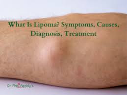 what is lipoma symptoms causes