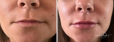 non surgical lip augmentation boston