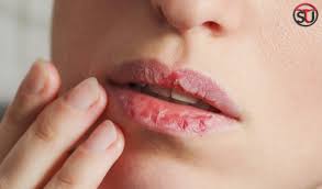 5 home remes to heal chapped lips