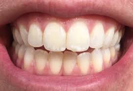 We all know that green tea is healthy, but it. White Spots On Teeth What Can You Do Smile Stories