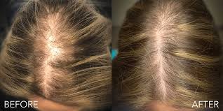 understanding female hair loss causes