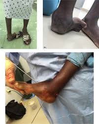 Most of the time, it is not associated with other problems. Treatment Of Relapsed Residual And Neglected Clubfoot Adjunctive Surgery Journal Of Children S Orthopaedics