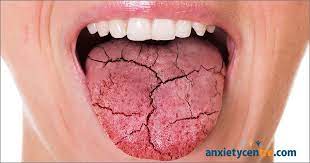 anxiety causes dry mouth xerostomia