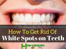 Find out why you have white spots on your teeth and what you can do to remineralize your teeth and prevent the appearance of white stains of your teeth. Pin On Good Oral Hygiene