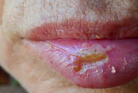 cold sores signs and symptoms