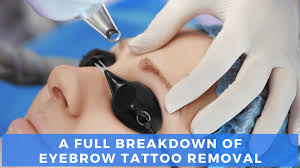laser eyebrow tattoo removal our