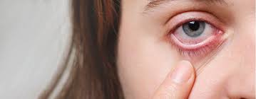 what is pink eye shroff eye centre