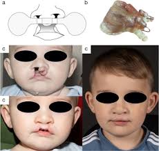 uk cleft lip and palate care a