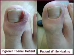 ingrown toenail onychocryptosis