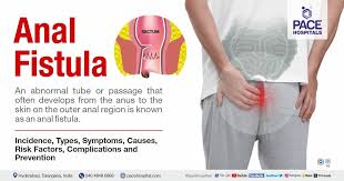 fistula symptoms causes types