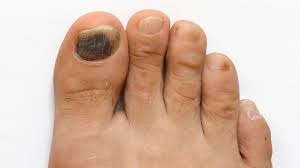 fungal toenails k foot ankle