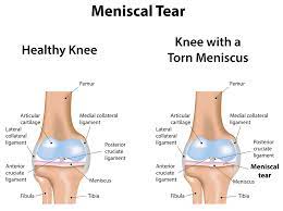 knee meniscal tear physiotherapy