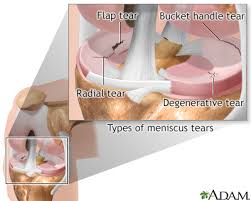 meniscus tears aftercare information