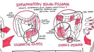 Inflammatory Bowel Disease Crohns And Ulcerative Colitits