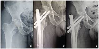 part intertrochanteric femur fractures