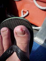 er or not really bad stubbed toe