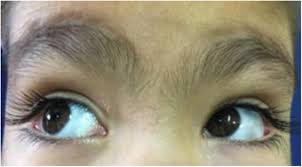 ocular motility in kabuki syndrome