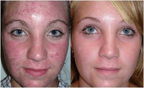 acne piedmont preferred women s