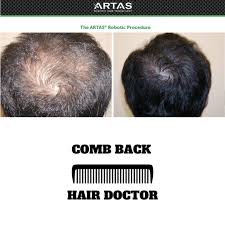 Previous hair transplant methods such as the strip method require invasive surgery, iv sedation and extended recovery period, and leave noticeable linear scars across the scalp. Hair Restoration San Diego Hair Restoration San Diego