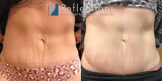 stretch mark removal before after
